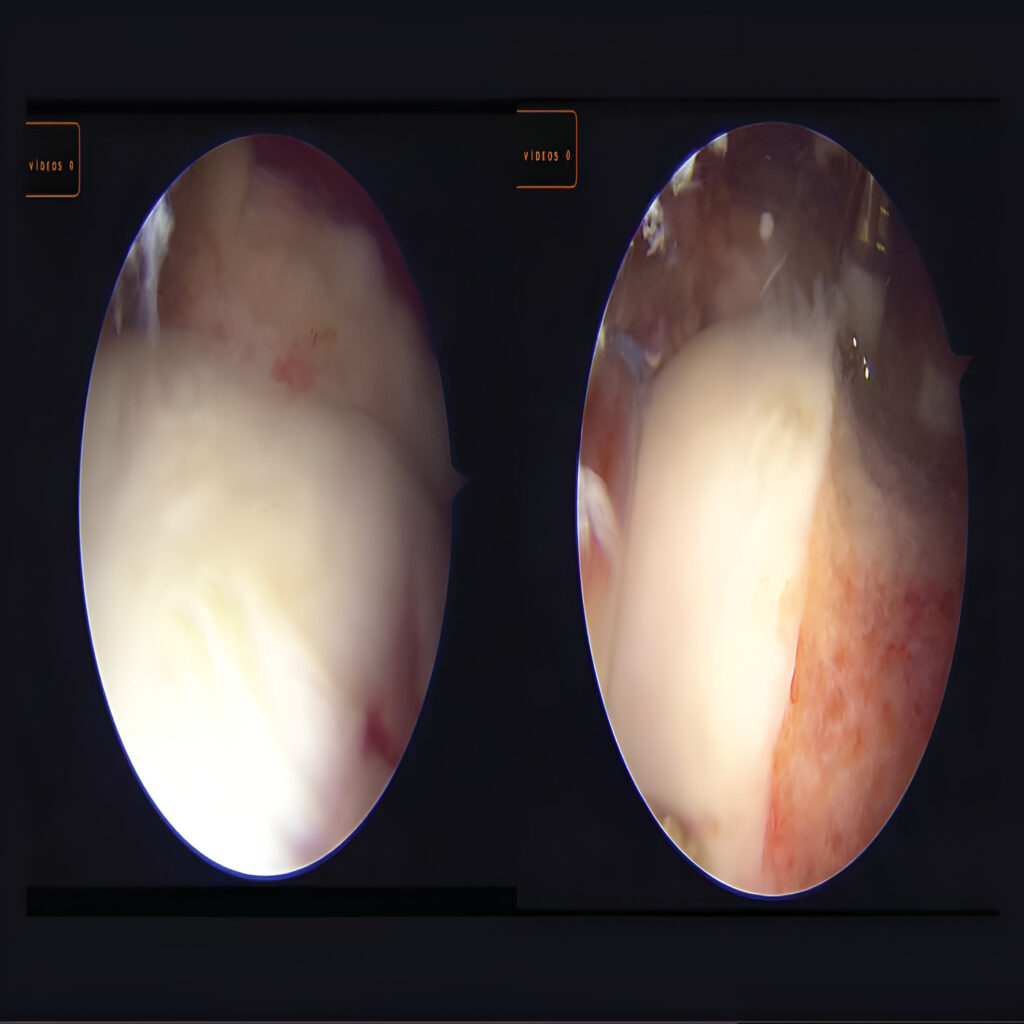 Imagen artroscópica de corrección de deformidad tipo Cam en la cadera mediante remodelación ósea