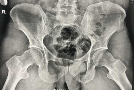 Radiografía de paciente con pinzamiento femoroacetabular de la cadera mostrando deformidades óseas